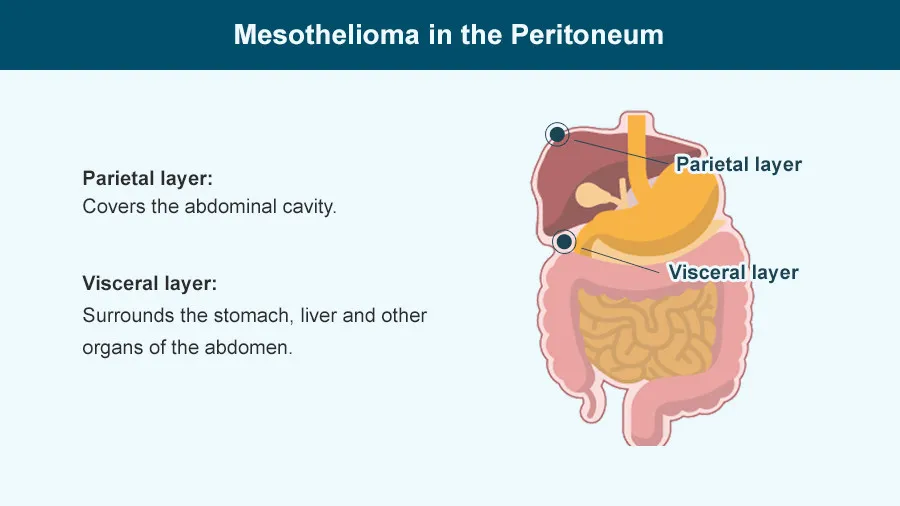 Mesothelioma abdomen: Cancerous abdominal lining.