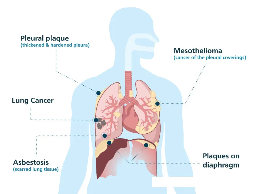 Mesothelioma affects what membrane: Pleura.