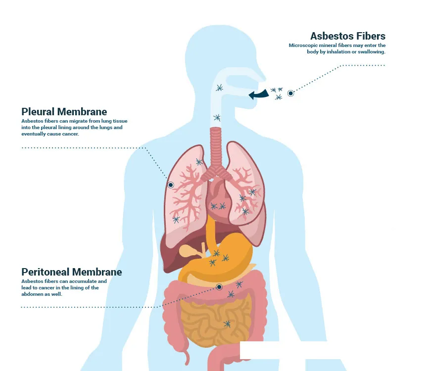 Mesothelioma asbestos: Lung cancer link.