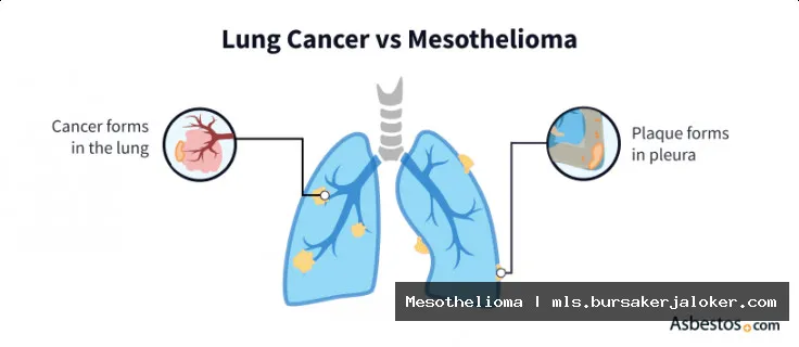 Mesothelioma asbestos exposure: Damaged lung.