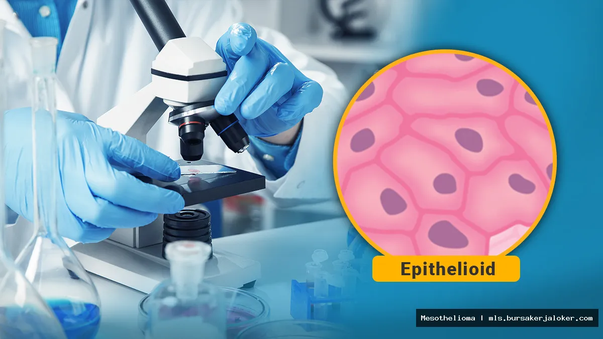Mesothelioma epithelioid: Microscopic cancer cell view.