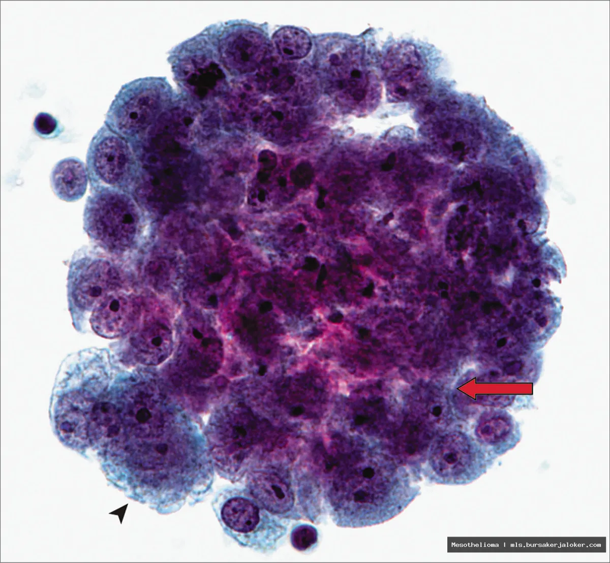 Mesothelioma gross: Lung tissue abnormality.