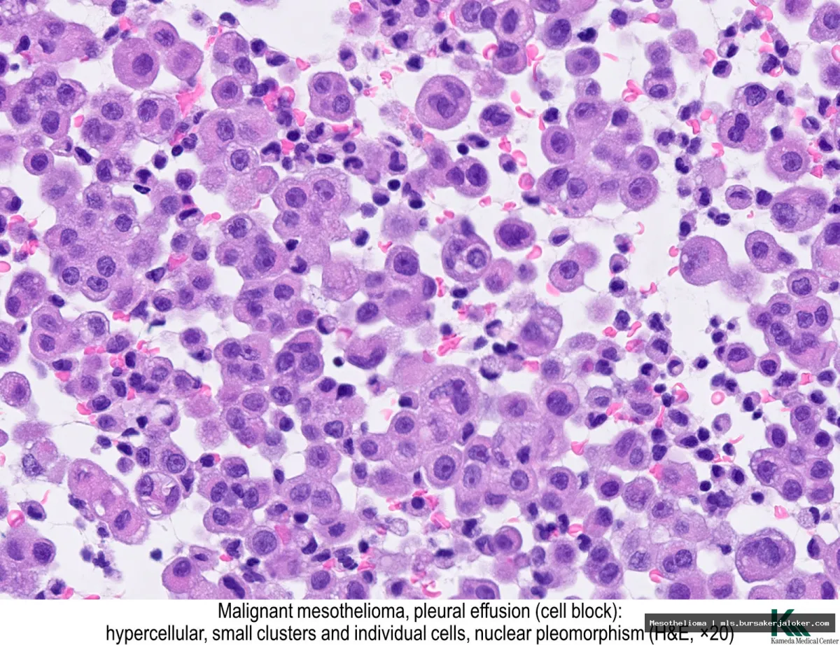 Mesothelioma histology: malignant cell features