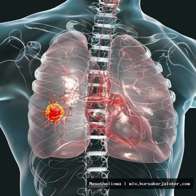 Mesothelioma in Spanish: informational graphic.