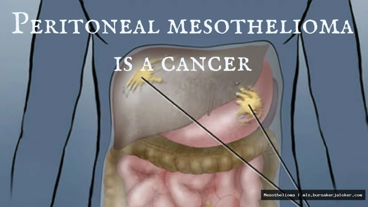 Mesothelioma in stomach: Cancer illustration.