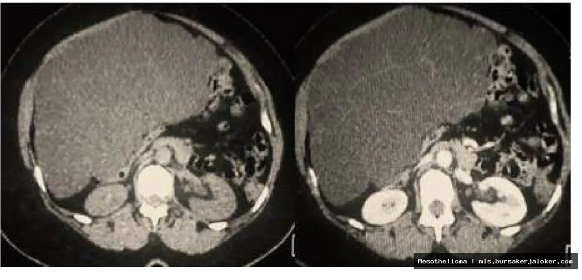 Mesothelioma kidney: rare tumor growth.