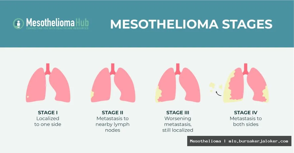 Mesothelioma metastasis: cancer spreading illustration