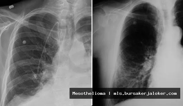 Mesothelioma misdiagnosis: diagnostic challenges faced.