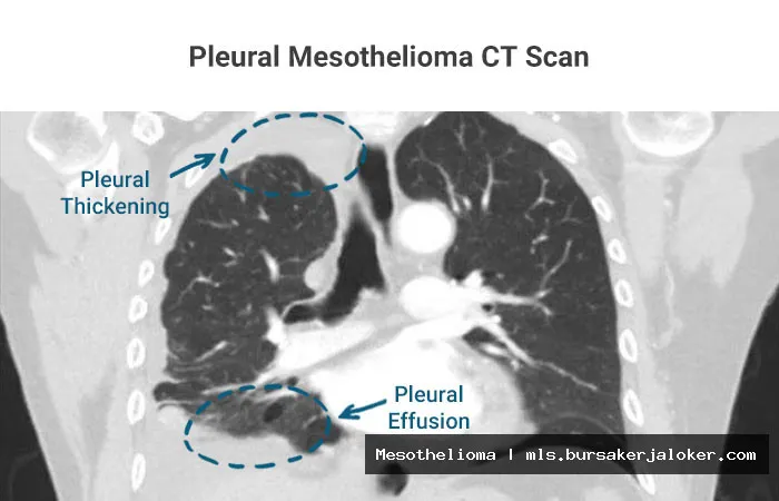 Mesothelioma pleural: Cancer in lung lining.