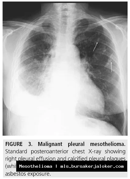 Mesothelioma radiology: Imaging reveals tumor.