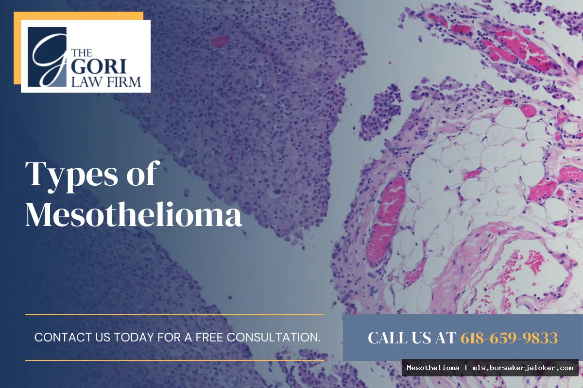 Mesothelioma types: a brief overview.