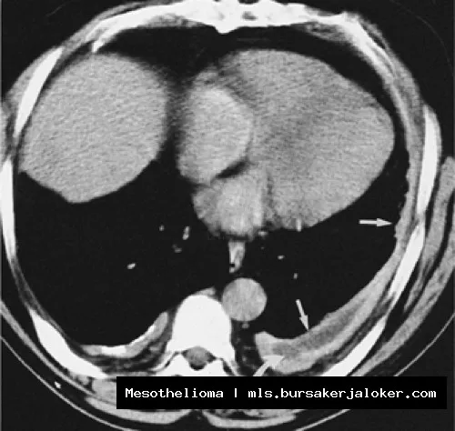 Mesothelioma Uptodate: Information and Resources.