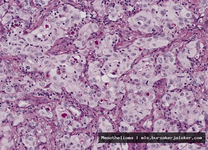 Mesothelioma USMLE: Cancerous cell illustration.