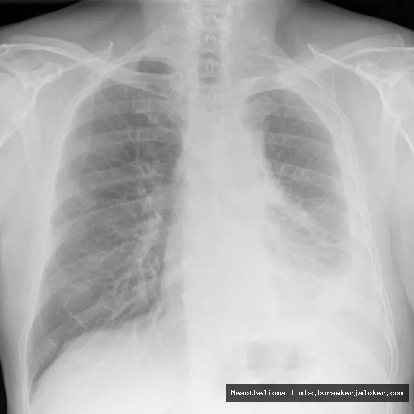 Mesothelioma x-ray findings: pleural thickening.